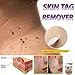Gonikm Strength Skin Tag Remover Foot Treatment Mole Skin Tag Body Warts Remover Athletes Foot Remediesthumb 1