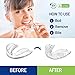 VieBeauti Professional Moldable Mouth Guard, Dental Night Guard for Grinding Teeth, 2 Sizes, 4 Pieces New Upgraded Night Dental for Teeth Grinding,Eliminates Bruxism & Teeth Clenching
