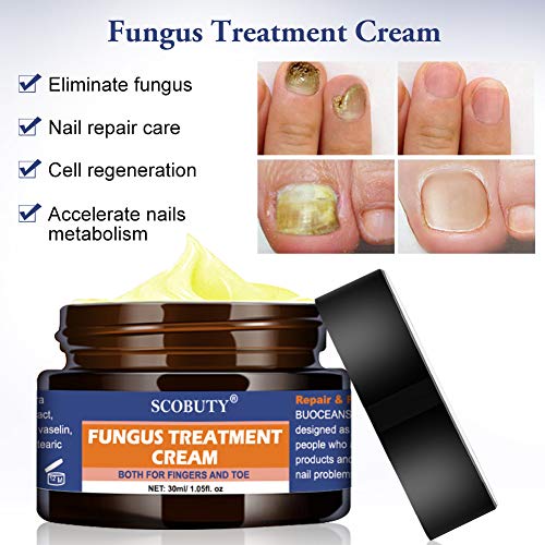 Fungus Cream, Nail Fungus Cream, Fungus Stop, Foot Fungus, Nail Repair