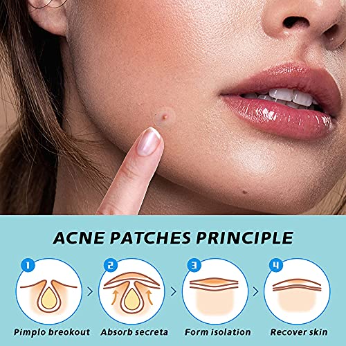QTH Acne Pimple Patches (72 Count) Hydrocolloid Healing Acne Patches