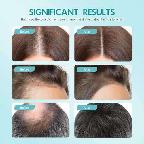 Crema de masaje para el cuero cabelludo con minoxidil al 5%, suero para el crecimiento de las trenzas Minoxidil, acondicionador suavizante para las trenzas (2pcs)