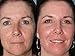 TCA 50% Tattoo removal, Skin tags, Warts, Age Spots, Freckles (1/2 oz) (15ml) by RePare Skincare