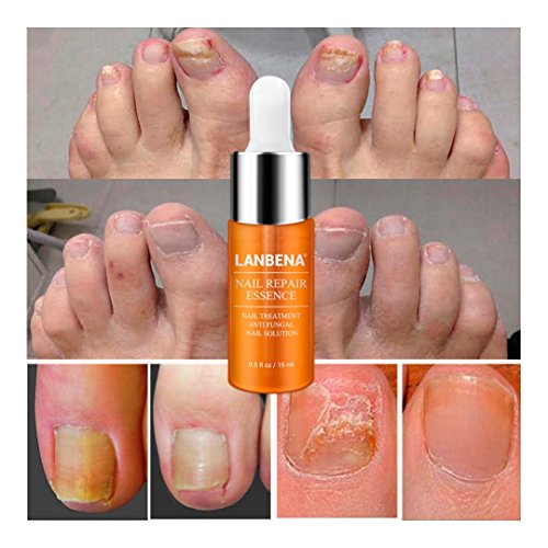 Nail Toenail Fungus Treatment, Fungus Stop Effective Anti Against Nail Fungus Solution Set (15ml)