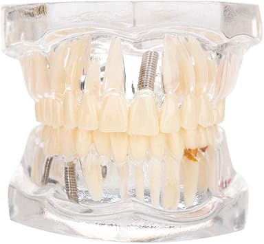 Nerf Dent Molaire - Trouvez Des Images De Stock De Dent Cassée, Molaire Basse Gauche, Fracture En Hd Et Des Millions D�autres Photos, Illustrations Et Images Vectorielles De Stock Libres De Droits Dans La Collection.