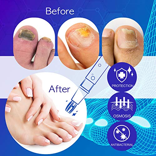 Nail Fungus Treatment Pen, Nail Fungus Treatment for Toenail Pen