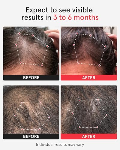 iRestore Professional Laser Hair Growth System-FDA Cleared Laser Cap Hair Growth for Men & Hair Regrowth Treatments for Women, Hair Loss Treatments Hair Cap, Like Laser Comb for Hair Growth Products