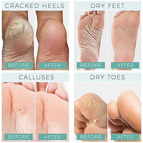 Foot Peel Mask - 2 Pack - For Cracked Heels, Dead Skin and Calluses - Make Your Feet Baby Soft and Get Smooth Silky Skin - Removes Rough Heels, Dry Toe Skin - Natural Treatment - Cruelty-Free and Vegan - Thumbnail 2