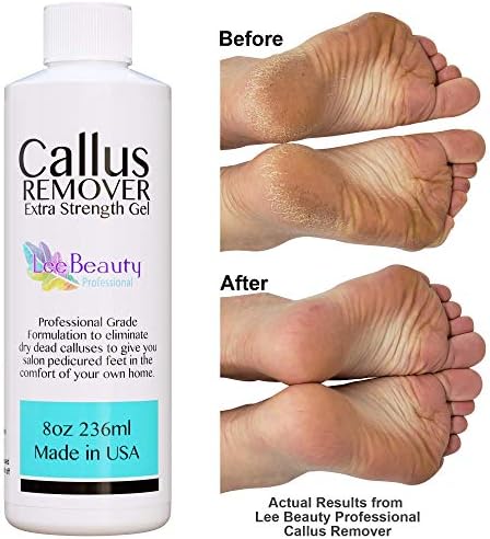 lee beauty professional callus remover