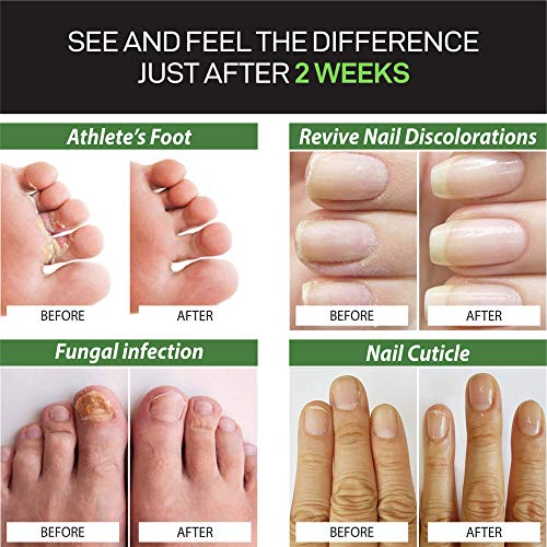 DAILY REMEDY Premium Anti-Fungus Nail Treatment – Antifungal Toe