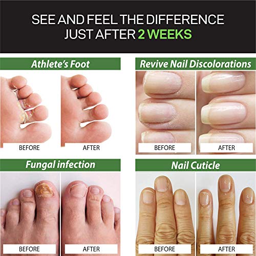 All Natural Nail Fungus Treatment – Made in USA, Best Nail Repair Product, Stop Fungal Growth, Effective Fingernail & Toenail Solution, Fix & Renew Damaged, Broken, Cracked & Discolored Nails