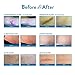 SIlicone Scar Sheets, 4pcs