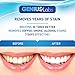 GENIUS Teeth Whitening Pen 4mL, Effective, Painless, No Sensitivity, Travel-Friendly, Easy to Use, Smart Whitening, Beautiful White Smile
