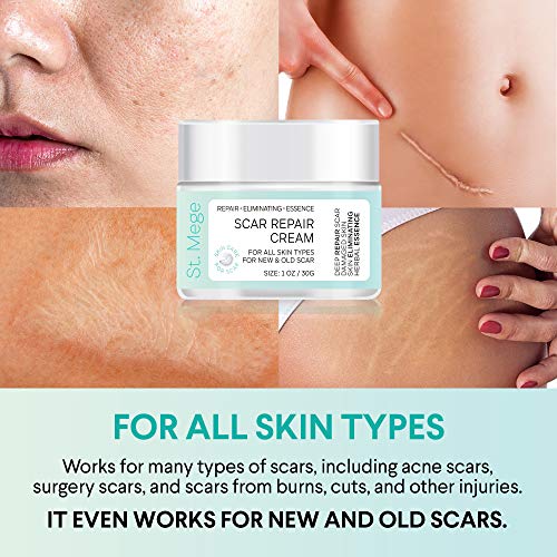 Scar Removal Cream, Scar Cream For Old Scars Stretch Mark Removal