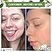 Keeva Organics Acne Treatment Cream With Secret TEA TREE OIL Formula - Perfect For Acne Scar Removal, Fighting Breakouts, Spots, Cystic Acne - See Results in Days Without Dry Skin (6oz)