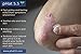 Psoriasis Cream (2oz) Treatment Cream Helps Symptoms Like Redness, Dry Patches, Plaque, Scales, Flakes by pHat 5.5