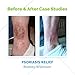 Skin MD Shielding for Face and Body, Relief for Irritated and Itchy Skin with Psoriasis (8 Ounce)