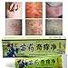Psoriasis Cream, Psoriasis Treatment Cream, Foot Cream, Natural Chinese herbal eczema ointment