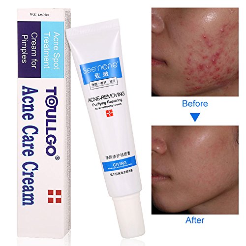 Cystic acne treatment, acne treatment cream, acne cream - acne, a…