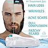 ALPHALUXY-Best-05mm-Derma-Roller-for-Hair-Beard-Growth-and-Acne-Scar-Treatment-Professional-Titanium-540-Needles-Microneedle-Dermaroller-Extensive-Instructions-Free-Ebook-Full-Warranty ALPHALUXY Best 0.5mm Derma Roller for Hair & Beard Growth and Acne Scar Treatment | Professional Titanium 540 Needles…