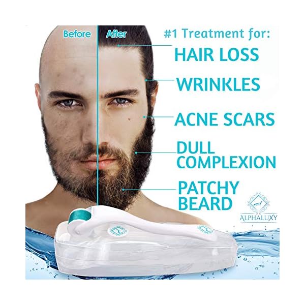 ALPHALUXY-Best-05mm-Derma-Roller-for-Hair-Beard-Growth-and-Acne-Scar-Treatment-Professional-Titanium-540-Needles-Microneedle-Dermaroller-Extensive-Instructions-Free-Ebook-Full-Warranty ALPHALUXY Best 0.5mm Derma Roller for Hair & Beard Growth and Acne Scar Treatment | Professional Titanium 540 Needles…