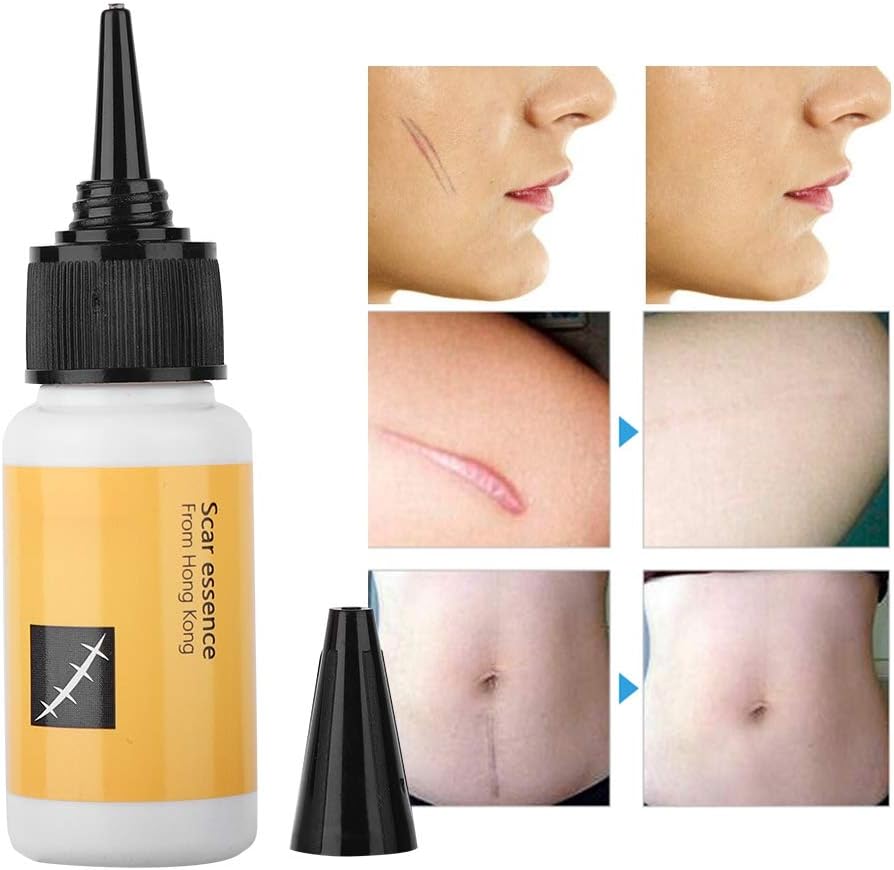 lidoria acne cream