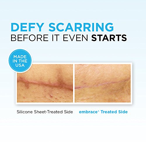 Embrace® Active Scar Defense Scar Treatment Best Therapy for Small