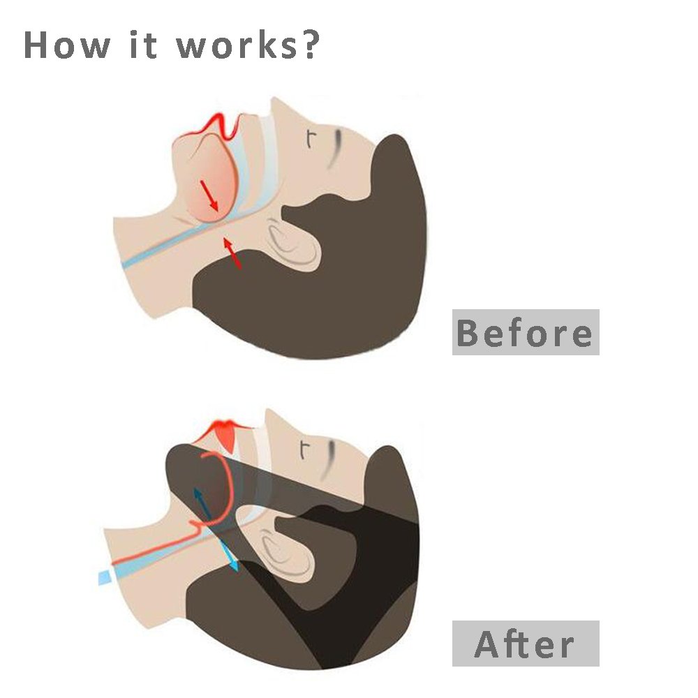 Anti Snoring Chin Strap - Adjustable Stop Snoring Solutions, Mouth Breathers Sleep Aid Devices for Men and Women