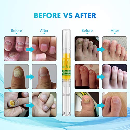 Bestidy Nail Treatment Repair Pen (2 Pens included), Onychomycosis Nail Care Solution-Repair and Strengthen Toenails and Fingernails - Thumbnail 3
