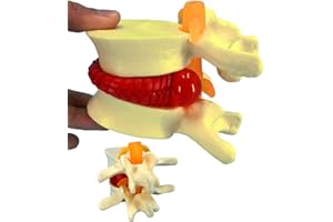 Veipho Human Anatomical Lumbar Disc Herniation Model, 1.5 Times Life Size Lumbar Disc Herniation Model, Human Lumbar Disc Herniation Model for Teaching, Learning, Demonstrating