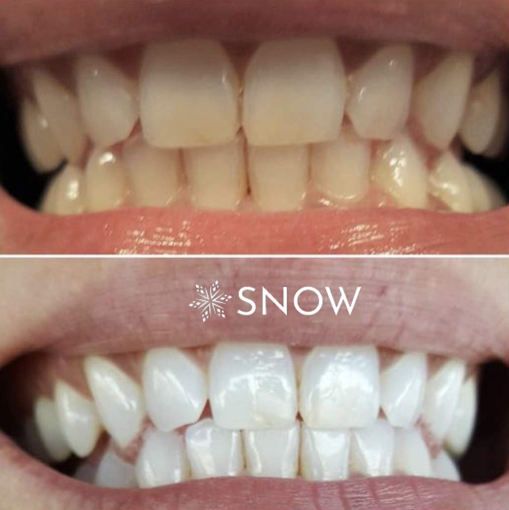 Snow Teeth Whitening How To Use TeethWalls