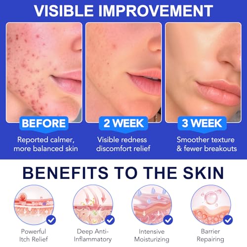 Folliculitis Cream 100g, Multi-Purpose Cream for Oily & Blemish-Prone Skin, Gentle Herbal Care for Smooth, Calm the Look of Redness, help reduce excess oil appearance, Suitable for Scalp, Face & Body