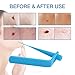 Premium Skin Tag Remover Device – Skin Tag Removal Kit Remove Medium to Large Skin Tagsthumb 3