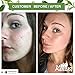 Keeva Organics Acne Treatment Cream With Secret TEA TREE OIL Formula - Perfect For Acne Scar Removal, Fighting Breakouts, Spots, Cystic Acne - See Results in Days Without Dry Skin (6oz)