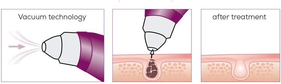 beurer power deep pore cleanser fc 40