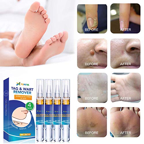 Tomiya Skin Tag Remover Wart Remover Quickly Remove Common And