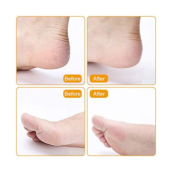 Foot Files for Hard Skin –Professional Pedicure Set [Pack of 15] Foot File Set, Stainless Steel Foot File Clean Foot…