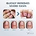 Vanish Fungal Nail Renewal, Nail Fungus Renewal Cream, Effective on Toenail and Fingernail Treatment | 3x more cream, 30ml | Helpful E-Book Included