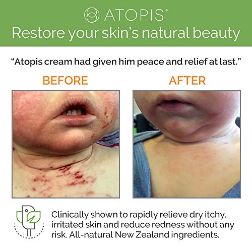 Atopis Eczema Cream for Adults, Children and Babies Clinically Proven