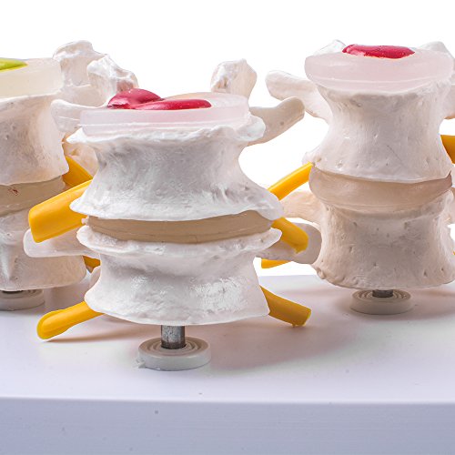 image for Zorvo 4-Part Anatomical Human Lumbar Vertebrae Degenerative Lumbar dis