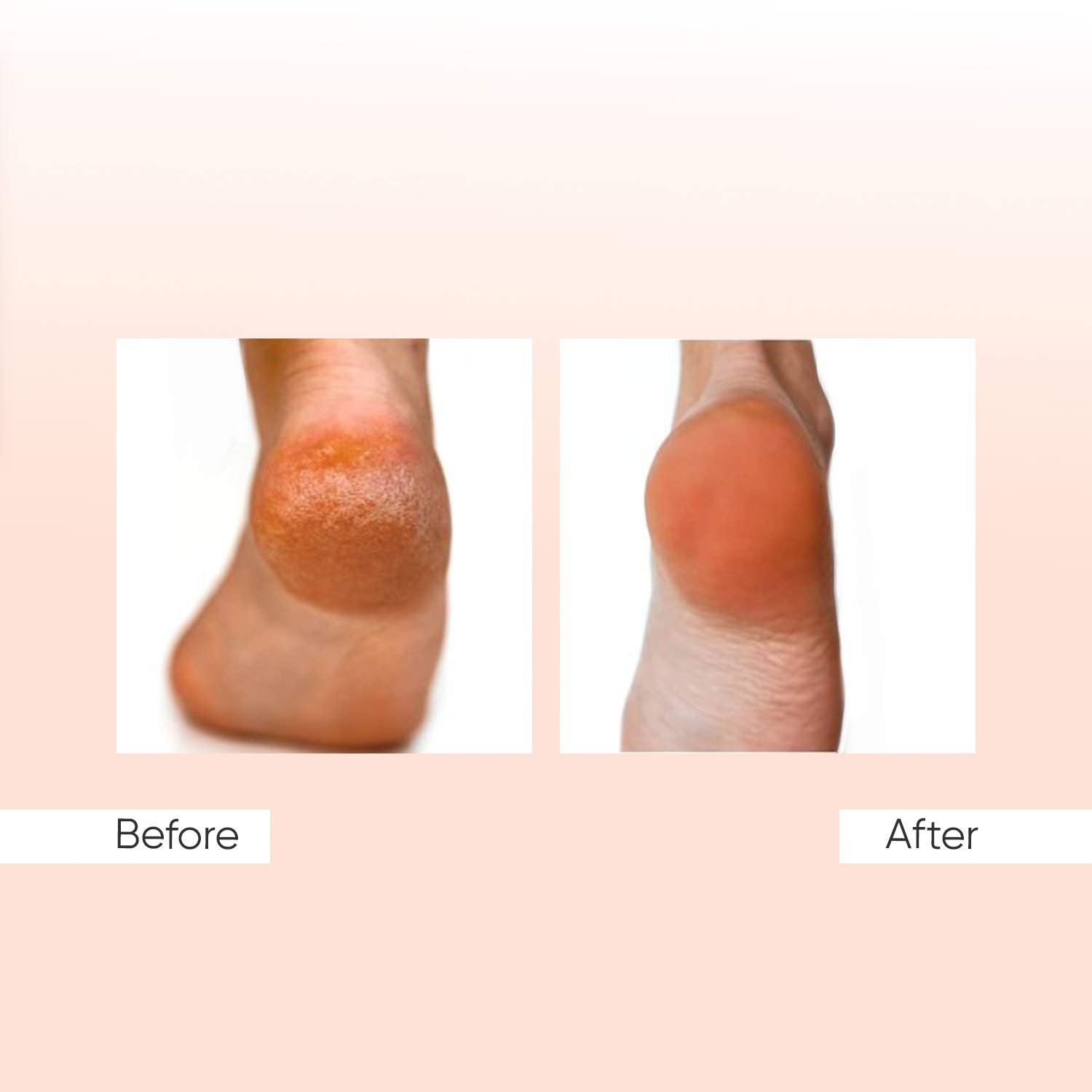 Sensimatch- Sensica\'s Portable Body Peeling And Pedicure Electronic Machine For A Rejuvenated Tighten Skin. Sensimatch Is A Great Callus For Feet, Legs Hands, Ankle, Heels, Back, Neck, Shoulders