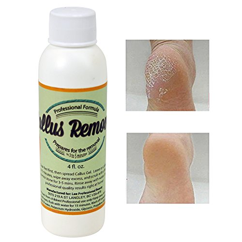 Best Callus Remover.Callus Eliminator,Liquid & Gel For Corn And Callus On Feet. Professional Grade, Does Better Job Than Electric Shaver&Other Scary Tools. 100% Satisfaction Guarantee or Money Back. Best Callus Remover.Callus Eliminator,Liquid & Gel For Corn And Callus On Feet. Professional Grade, Does Better Job Than Electric Shaver&Other Scary Tools. 100% Satisfaction Guarantee or Money Back.