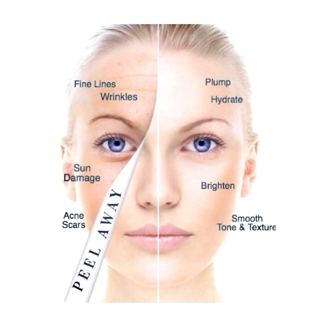 retinoid cream for wrinkles