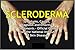 SCLERODERMA: Symptoms, Causes, Diagnosis and Effective Treatments - Official Guide from the National Institute of Skin Diseases