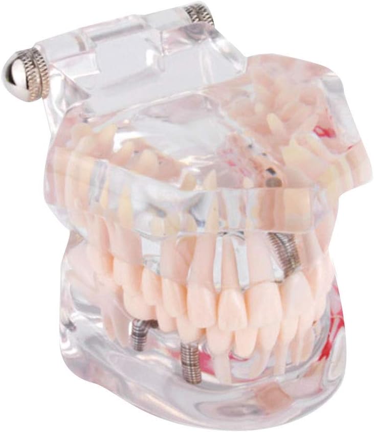 Teeth Model - Detachable Dental Oral Education Implant Caries Crown Bridge
