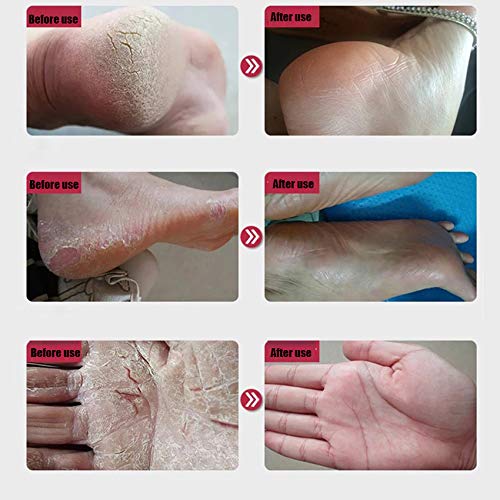 image for Iusun Beauty Iusun Heel Balm, Cracked Heel Balm Cream for Rough Dry & 