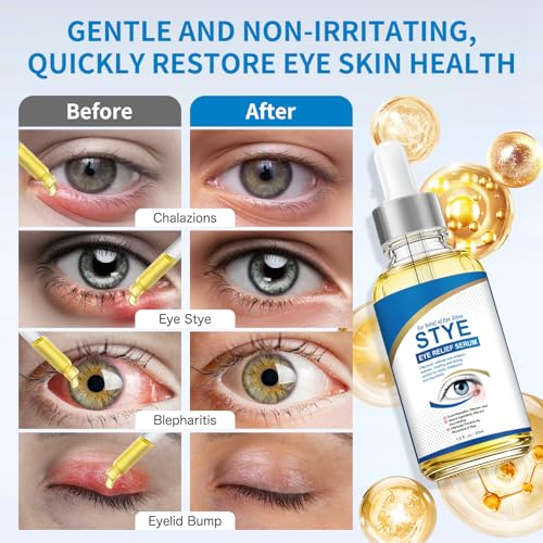 Stye Eye Treatment, Natural Stye Relief Serum for Chalazion, Blepharitis & Eyelid Bump, Gentle Soothing Eye Care for Swelling Redness Irritation (30 ml)