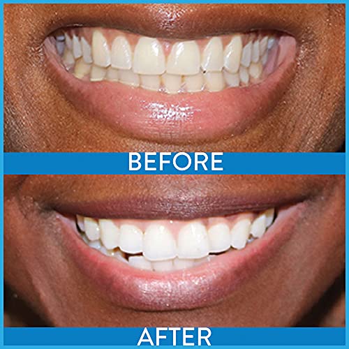 Power Swabs Teeth Whitening Kit Easy 7 Day Treatment for Whiter Teeth