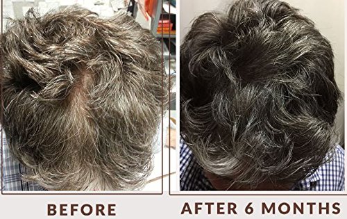 Natural Hair Loss Hair Growth Treatment - Hair Rescue Rx Men - Natural Hair Loss Supplement - Grow Thick Full & Healthy Hair Naturally - Hair Care Hair Loss & Hair Growth Product with Biotin - Thumbnail 4