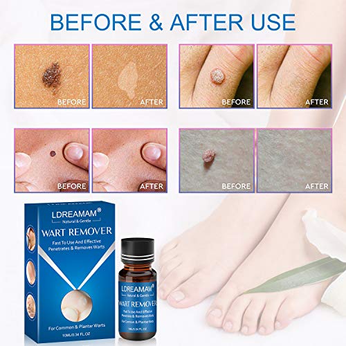 Wart Remover,Foot Wart Remover,Plantar Wart Remover,Wart Liquid,Painlessly Removes Common and Plantar Warts
