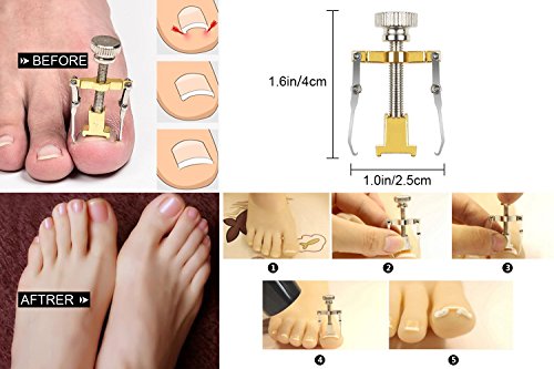 6 Pcs Ingrown Toenail Tools Kit - 6 in 1 Gold Professional Pedicure Toes Treatment Tools with Nail Corrector, Clipper, Cleaner, File for Thick Ingrown Toenails Correction Orthotic Appliance Set